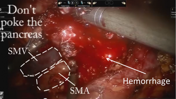 pancreas_1
